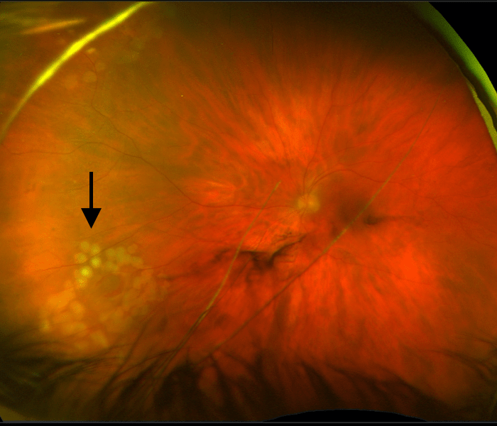 Retinal Tears and Detachments